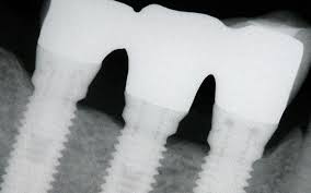 Online Residency Program: A-Z in Implant Dentistry