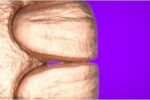 Vertical preparation protocols: The complete guide in 24 lessons from Tomorrow Tooth