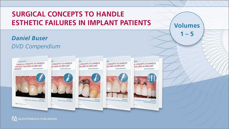 Surgical Concepts to Handle Esthetic Failures in Implant Patients Surgical Concepts to Handle Esthetic Failures in Implant Patients