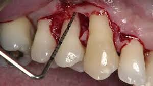 The Single Flap Approach: Regenerative Procedure Selection - Image 2