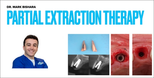 Partial Extraction Therapy Course Partial Extraction Therapy Course