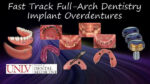 Full-Arch Dentistry – Implant Overdentures