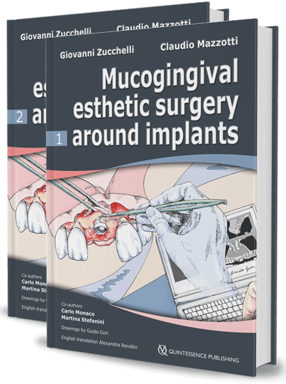 Mucogingival Esthetic Surgery Around Implants ( 2 Volumes) Mucogingival Esthetic Surgery Around Implants ( 2 Volumes)