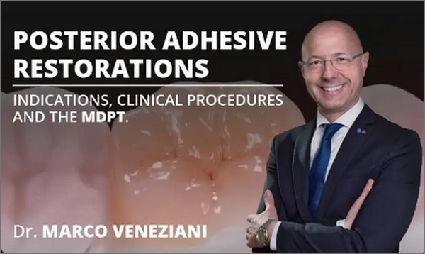Posterior Adhesive Restorations: Indications, Clinical Procedures and mDPT Techniques Posterior Adhesive Restorations: Indications, Clinical Procedures and mDPT Techniques