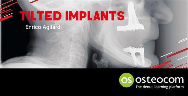 Tilted Implants: A Complete Surgical and Theoretical Guide to Tilted Implants Tilted Implants: A Complete Surgical and Theoretical Guide to Tilted Implants