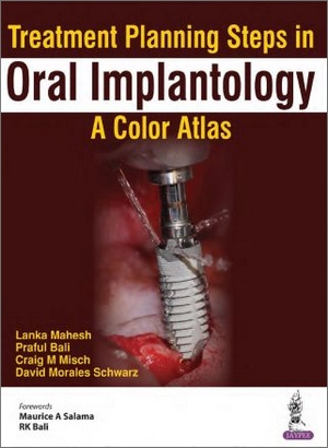 Treatment Planning Steps in Oral Implantology