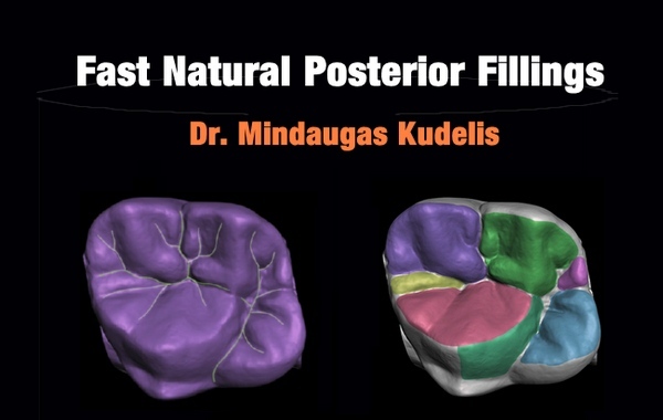 Fast Natural Posterior Fillings Fast Natural Posterior Fillings