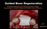 Guided Bone Regeneration: A 30 year Biological and Clinical Journey in Ridge Augmentation