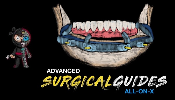 Implant Ninja, Advanced Surgical Guides – All on X Implant Ninja, Advanced Surgical Guides – All on X