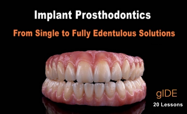 Implant Prosthodontics – From Single to Fully Edentulous Solutions Implant Prosthodontics – From Single to Fully Edentulous Solutions