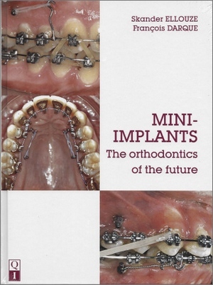 MINI-IMPLANTS: The Orthodontics of the Future (Scanned Copy) MINI-IMPLANTS: The Orthodontics of the Future (Scanned Copy)