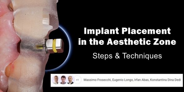 Implant Placement In The Aesthetic Zone Steps And Techniques Dentistry Ebooks 