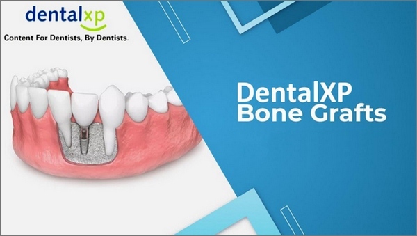 Vertical & Horizontal Bone Grafts (238 Lectues Collection)