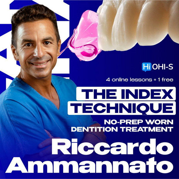 The Index Technique: No-prep Worn Dentition Treatment