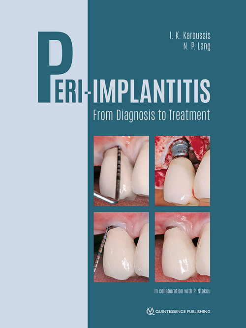Peri-Implantitis: From Diagnosis to Treatment Peri-Implantitis: From Diagnosis to Treatment