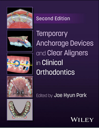 Temporary Anchorage Devices and Clear Aligners in Clinical Orthodontics Temporary Anchorage Devices and Clear Aligners in Clinical Orthodontics